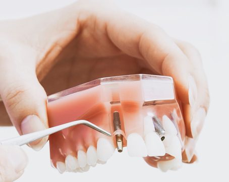 Implant procedure