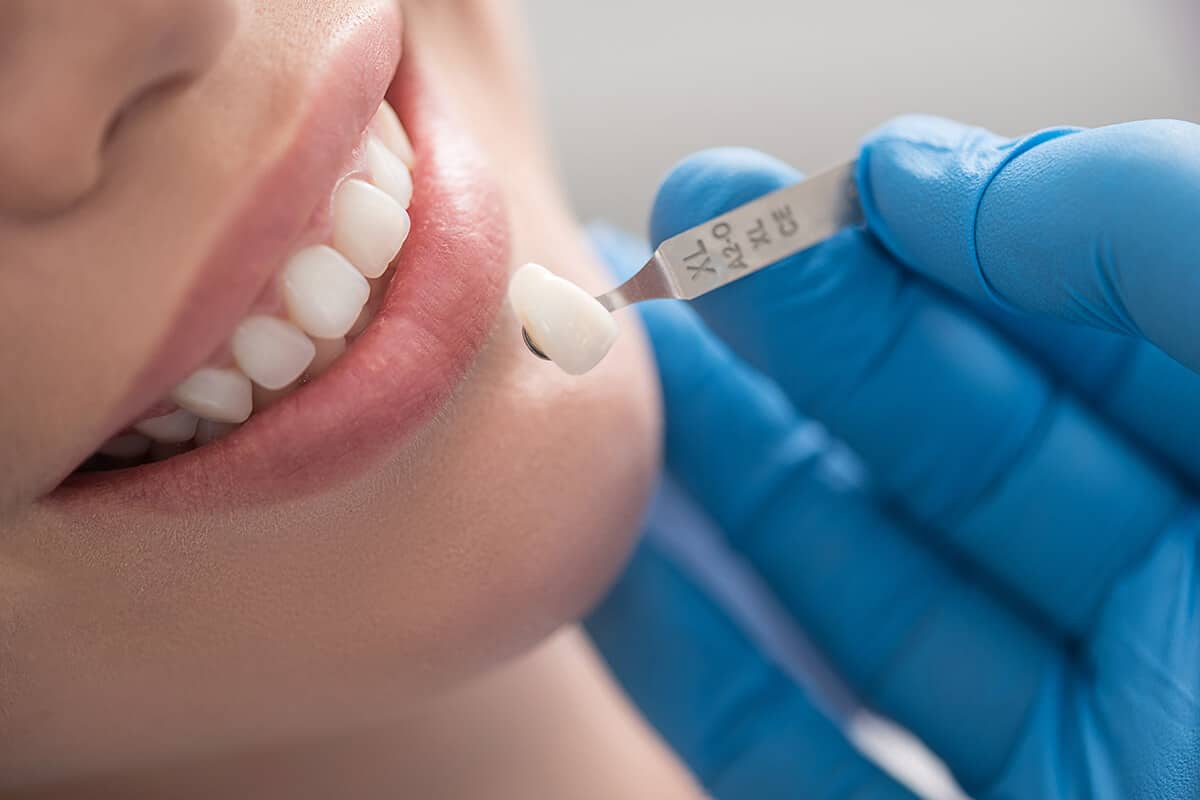 Dental crowns