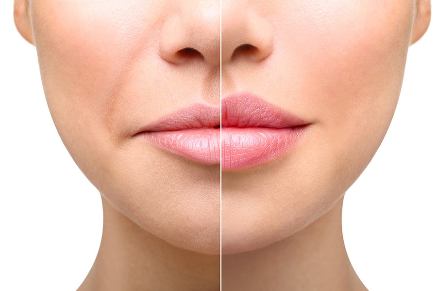 Dermal fillers