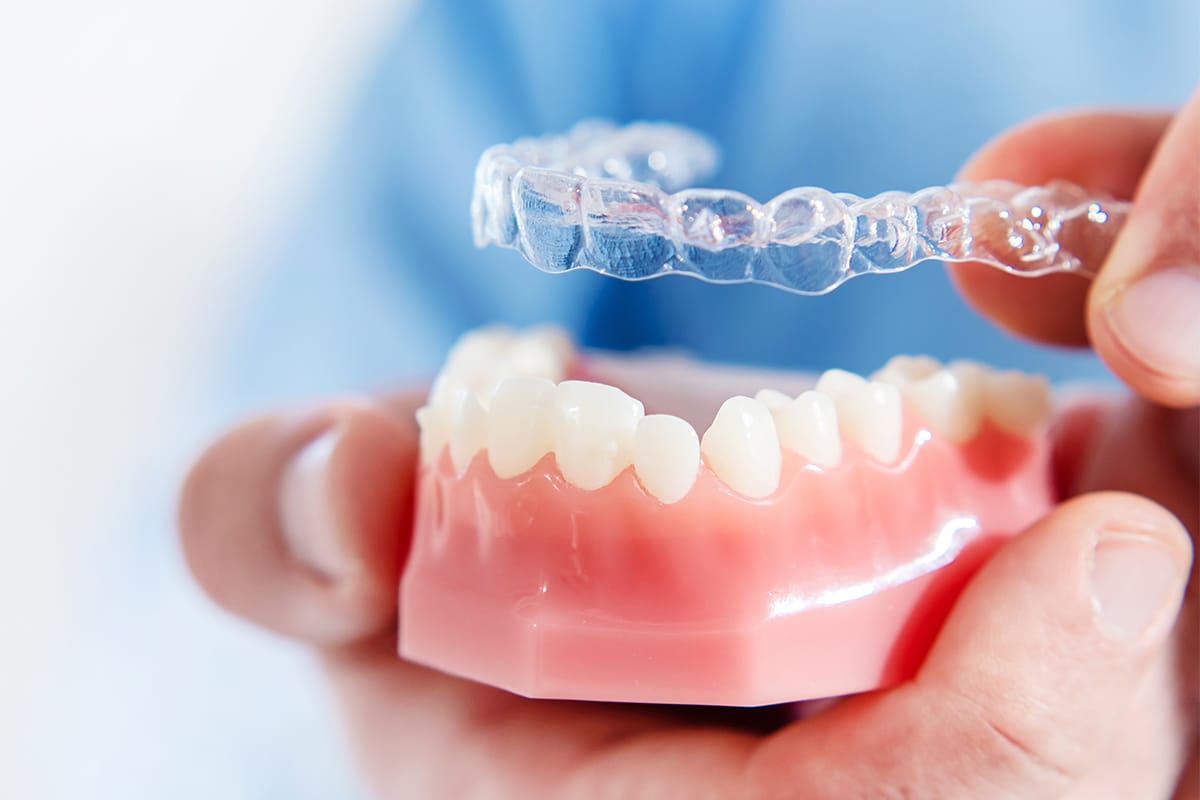 Invisalign clear aligners
