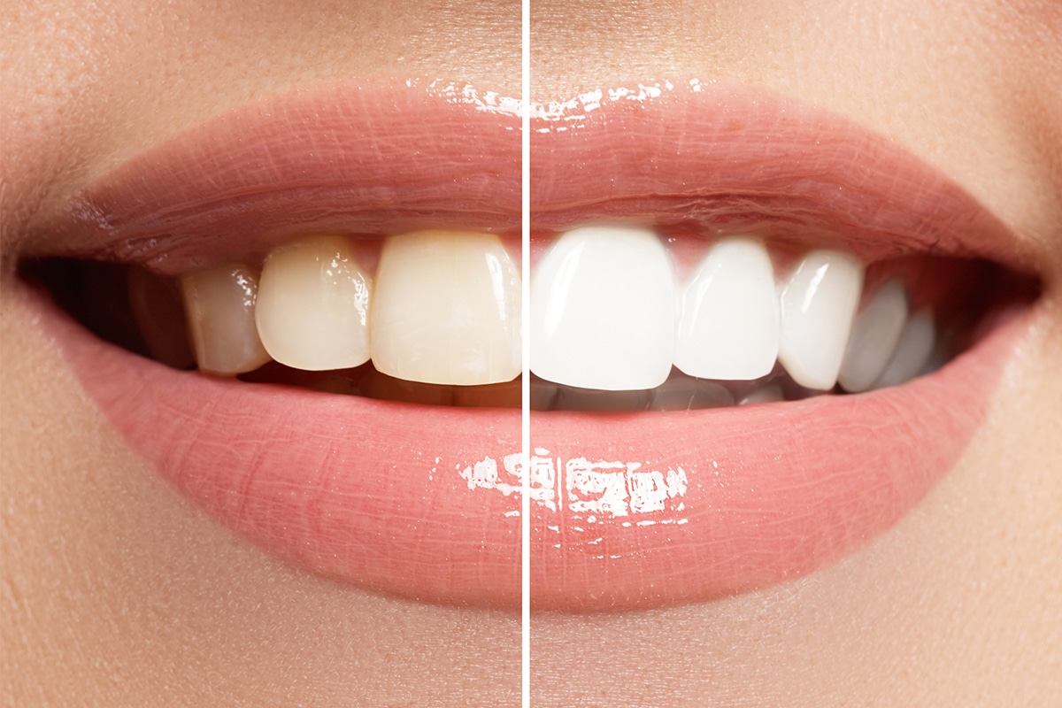 Teeth whitening