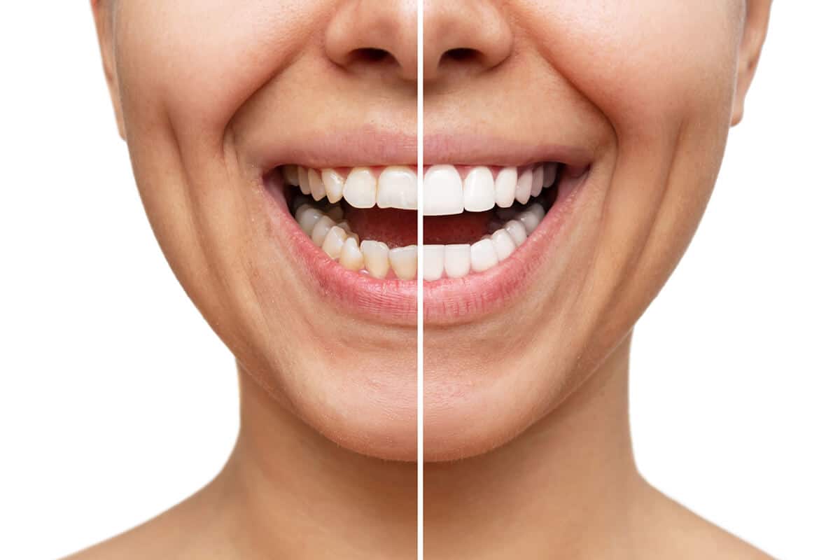 Porcelain veneers at A·Dent